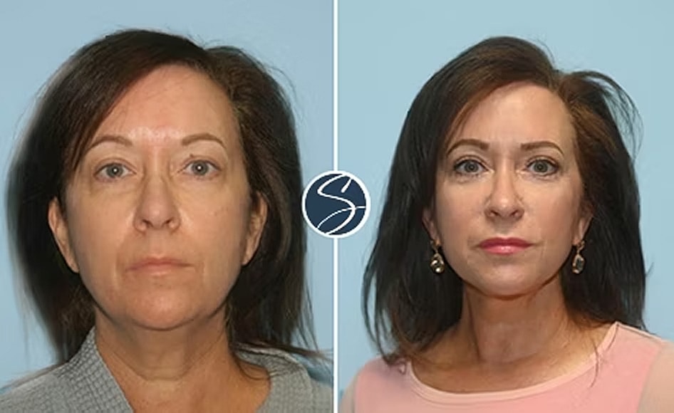 Before and after facial rejuvenation treatment images.