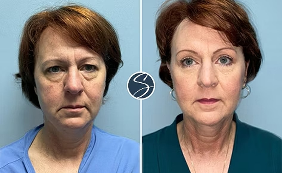 Before and after cosmetic transformation.