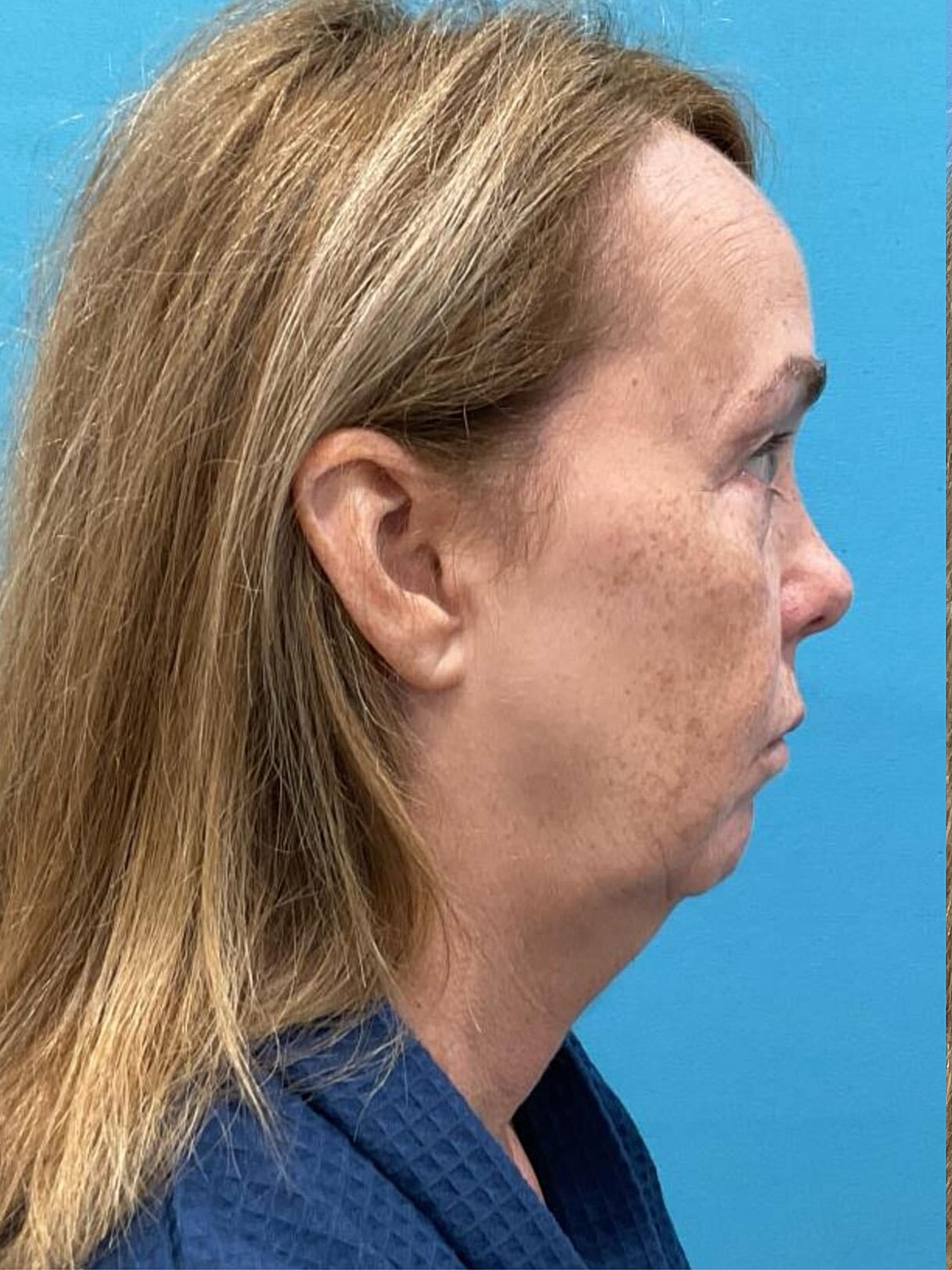 Facelift  Before & After