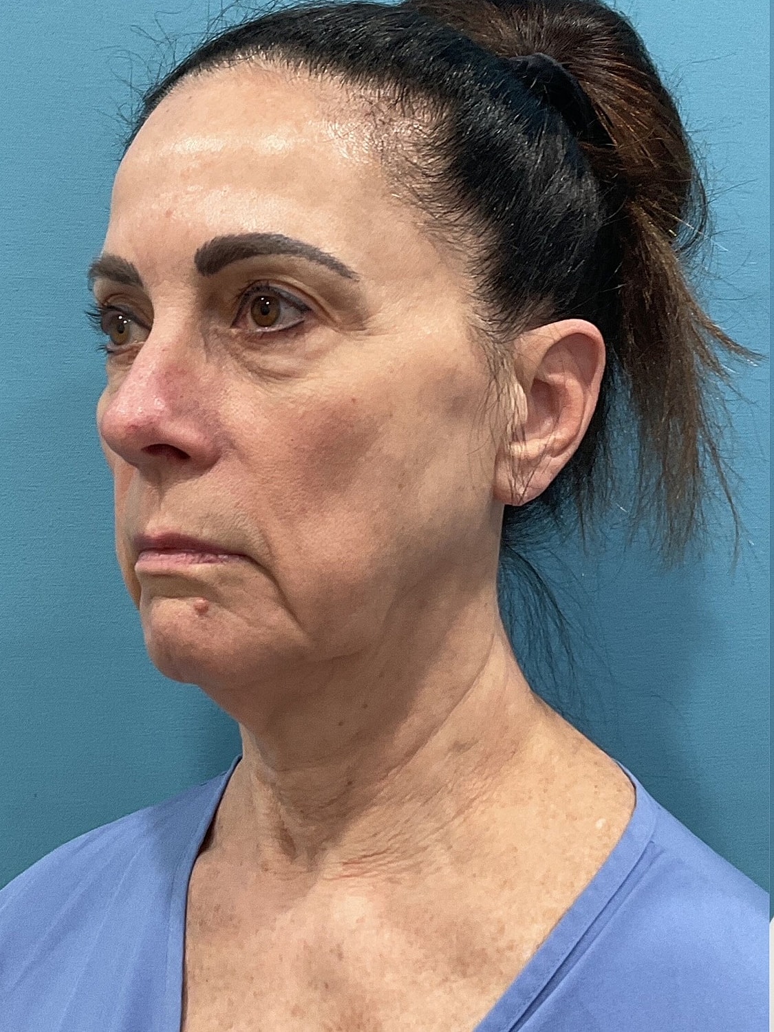 Facelift  Before & After