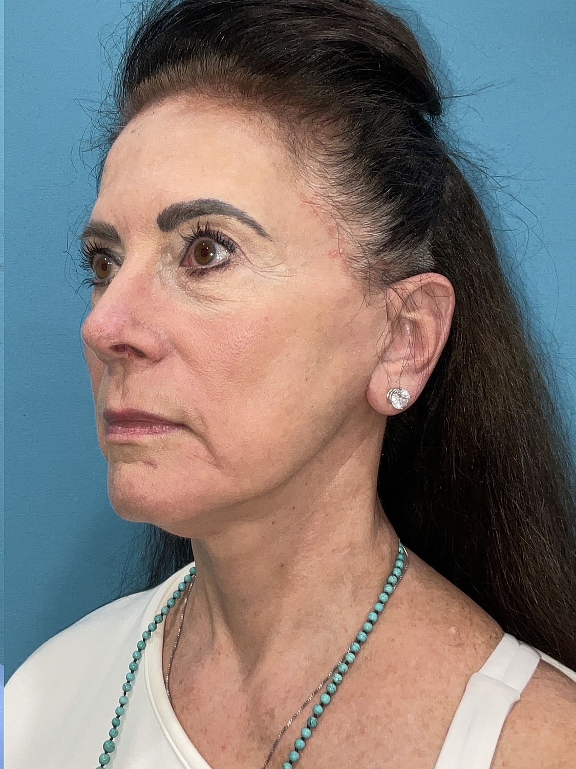Facelift  Before & After