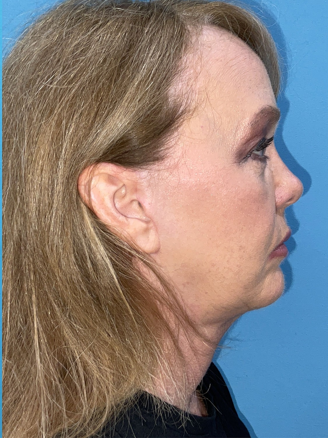 Facelift  Before & After