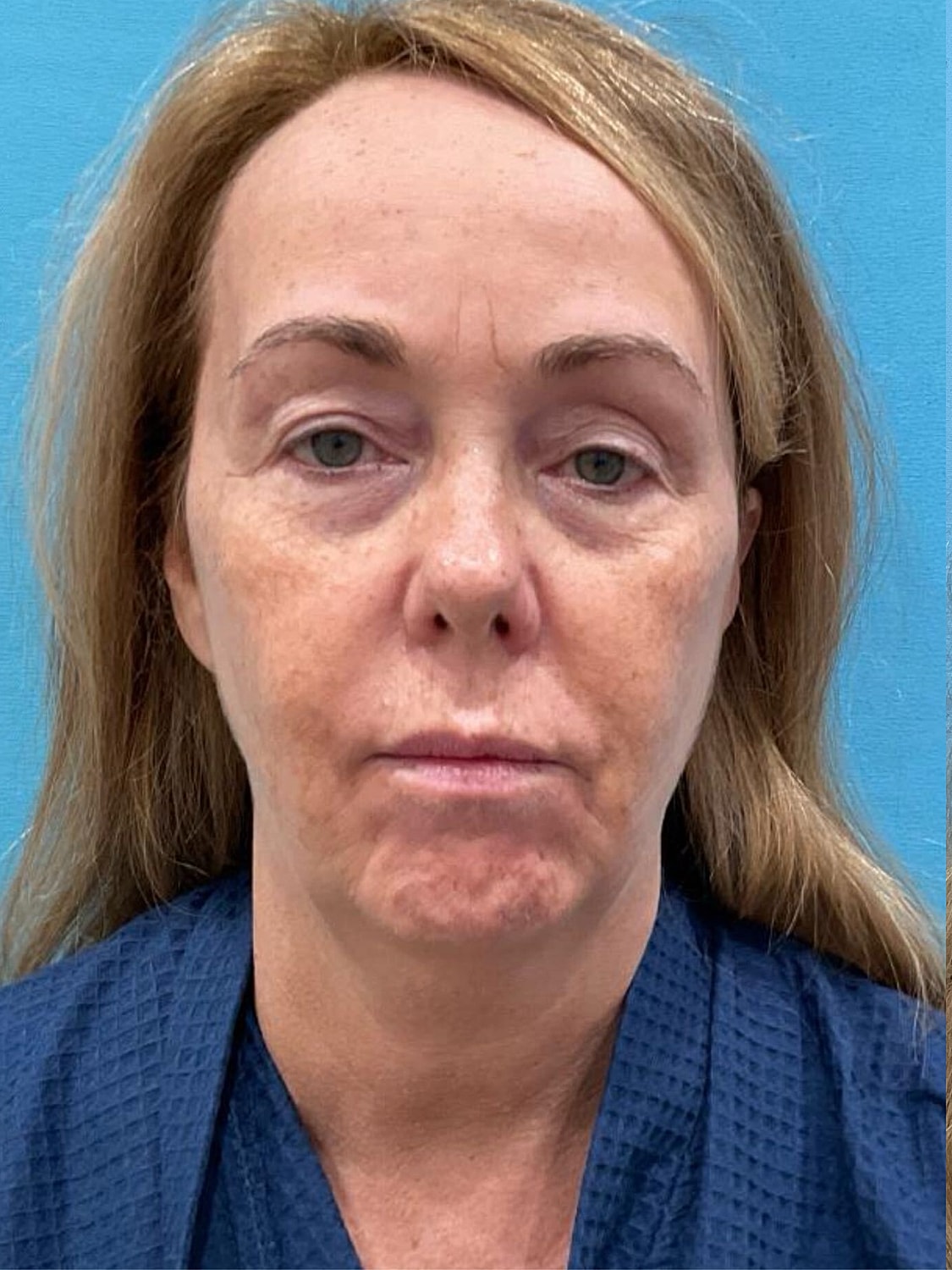 Facelift  Before & After