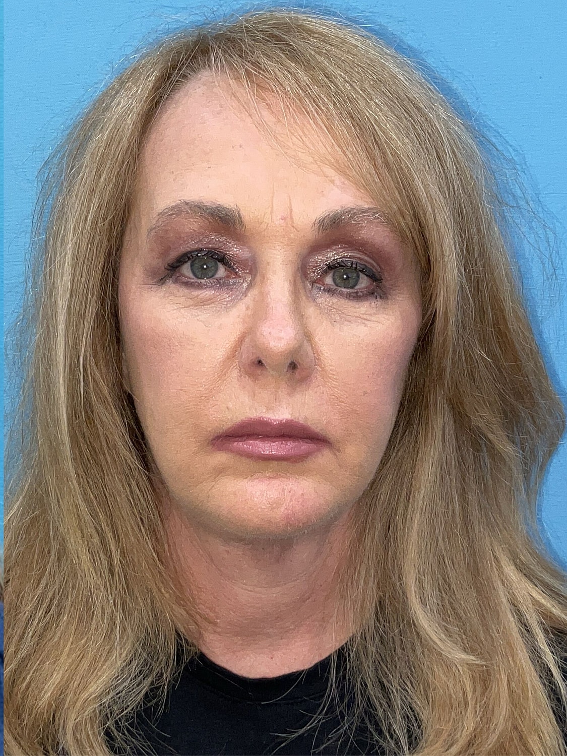 Facelift  Before & After