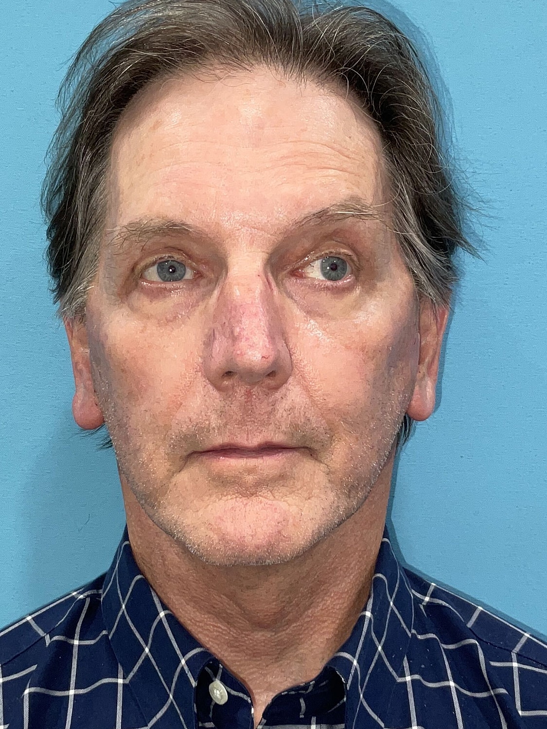 Facelift  Before & After