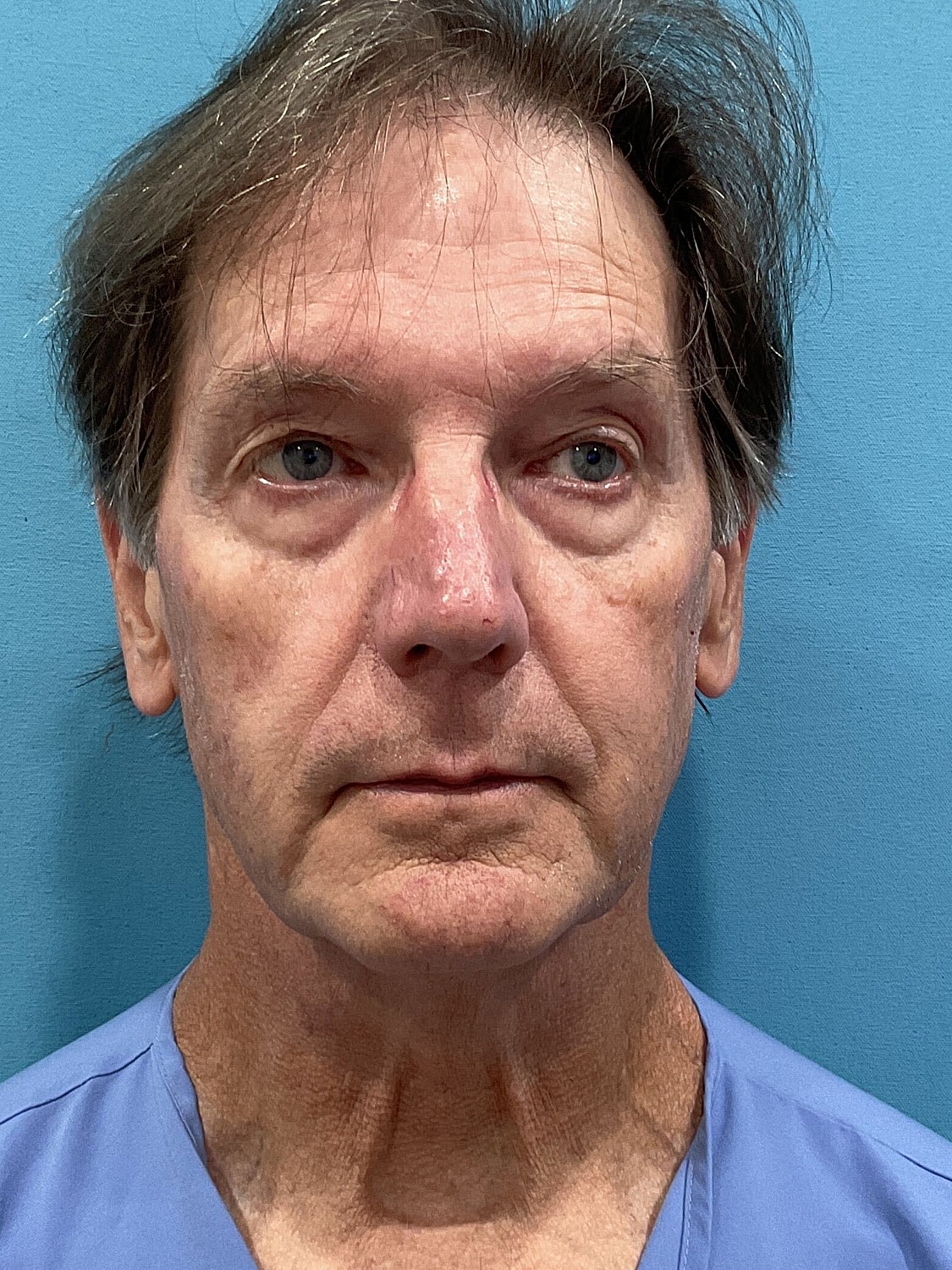 Facelift  Before & After