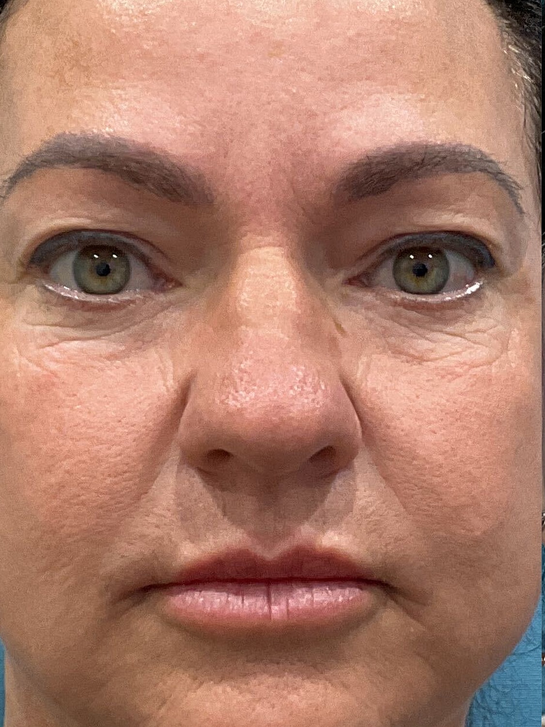 Blepharoplasty  Before & After