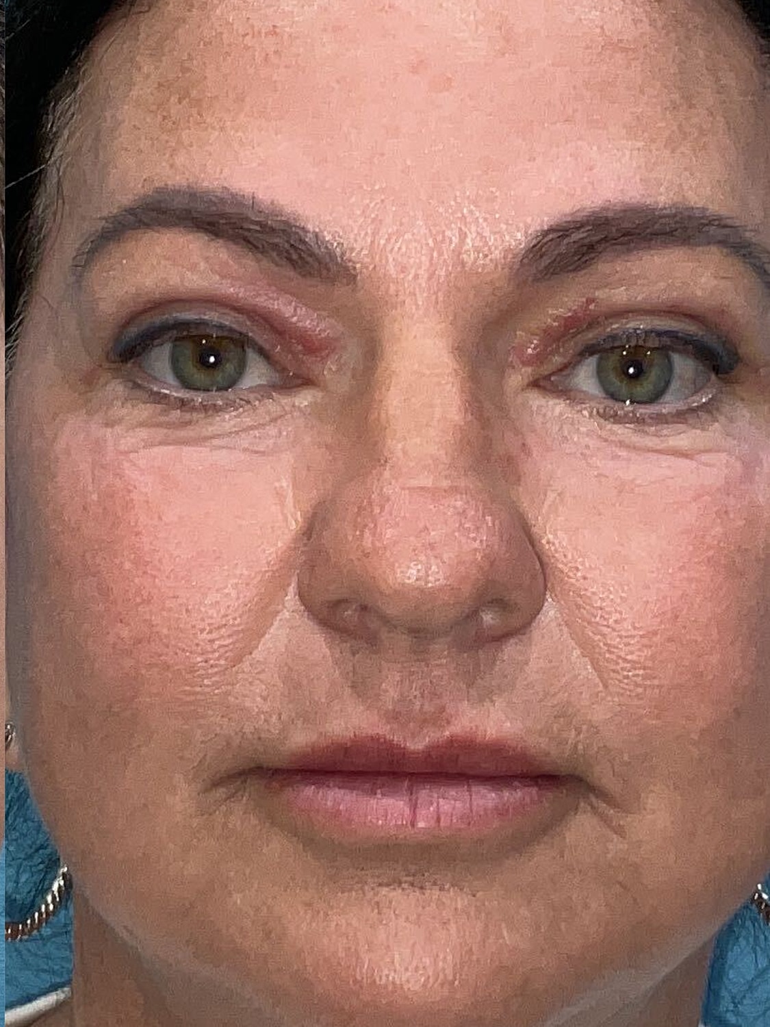 Blepharoplasty  Before & After