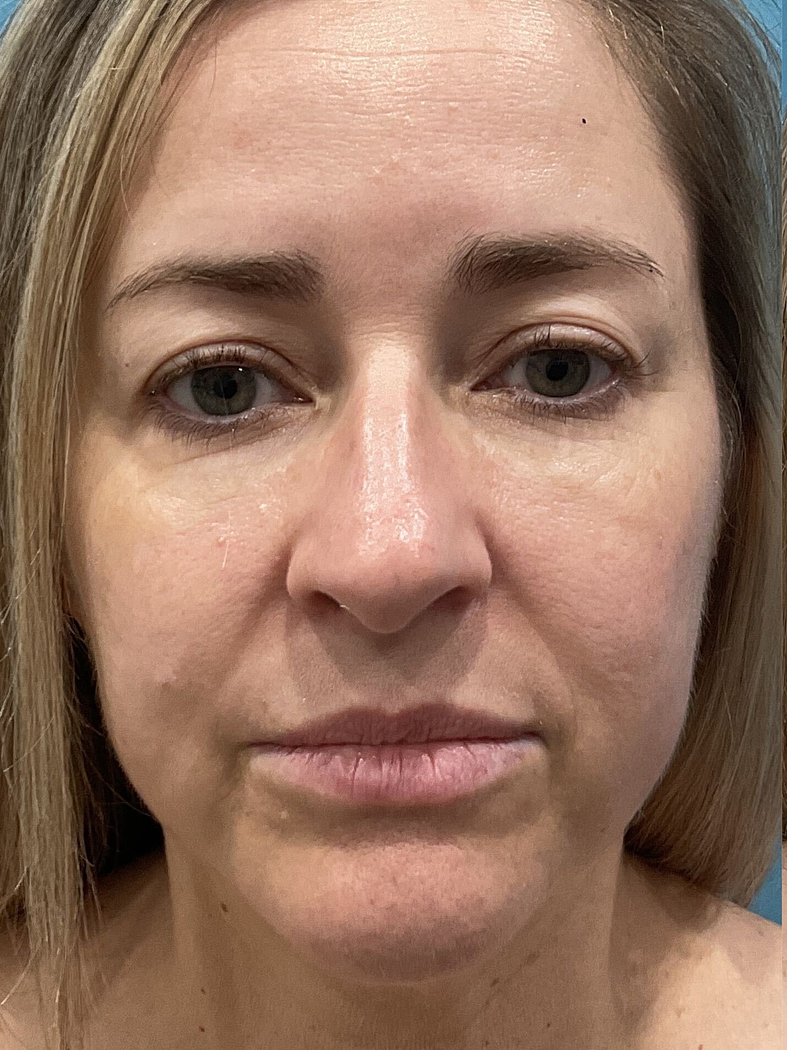 Blepharoplasty  Before & After