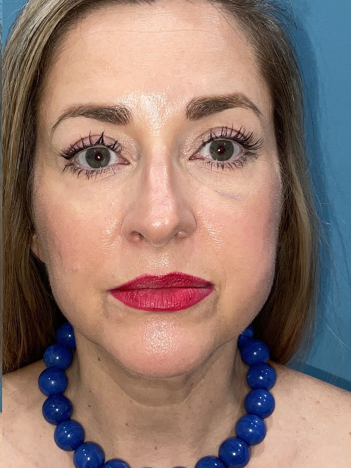 Blepharoplasty  Before & After