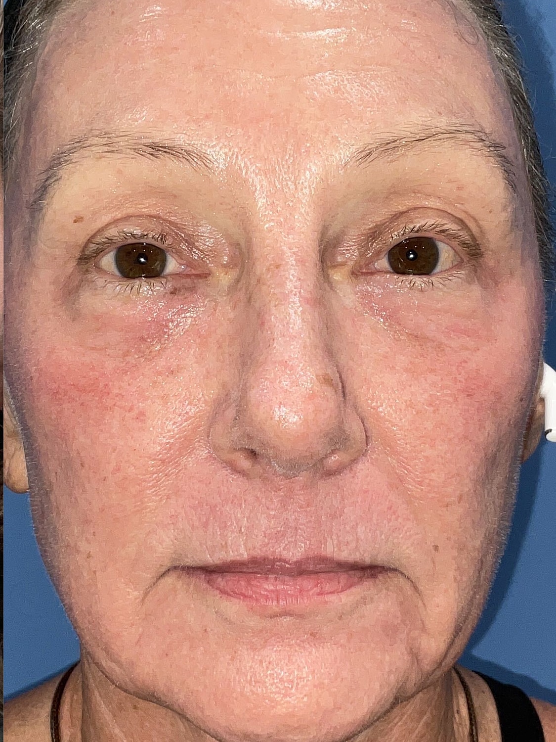 Blepharoplasty  Before & After