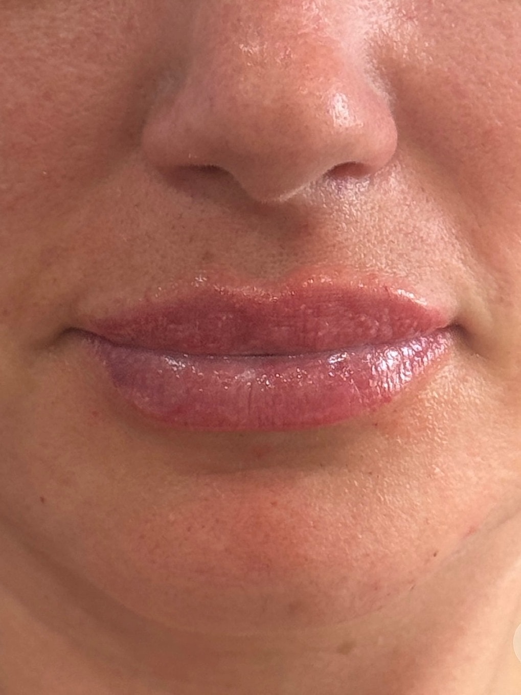 Dermal Filler  Before & After