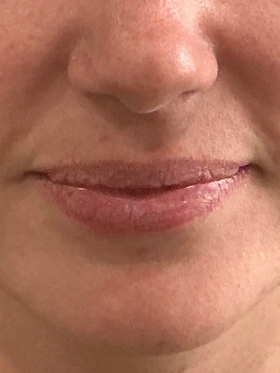 Dermal Filler  Before & After