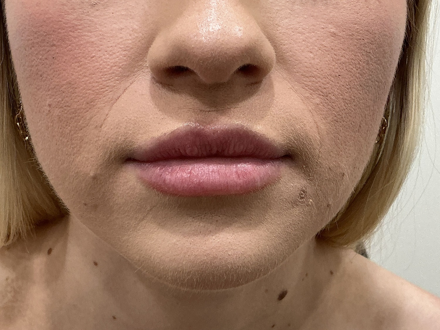 Dermal Filler  Before & After
