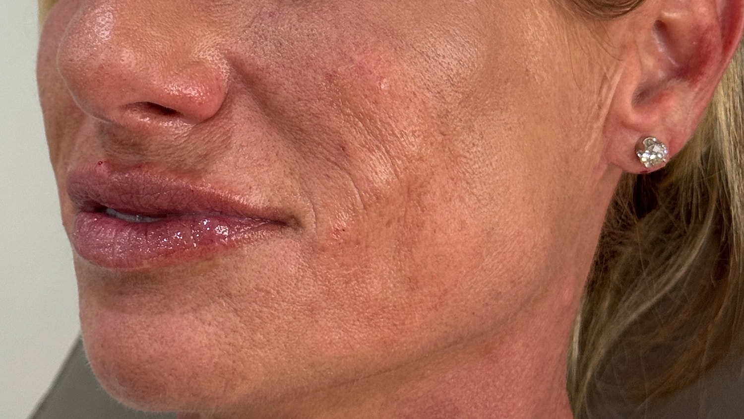 Dermal Filler  Before & After