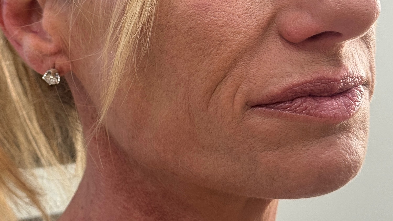 Dermal Filler  Before & After
