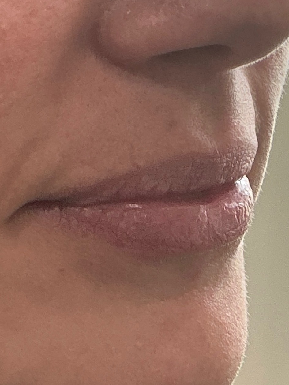 Dermal Filler  Before & After