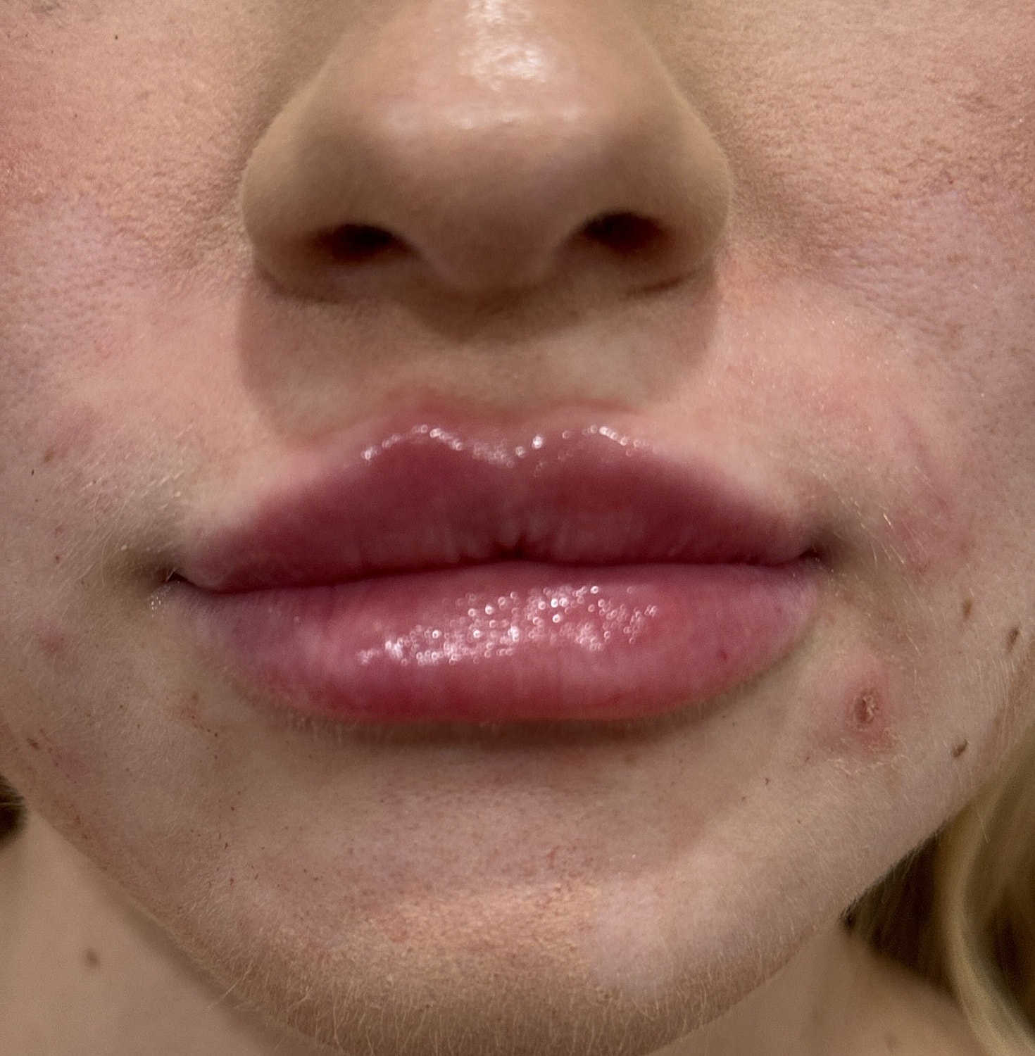 Dermal Filler  Before & After