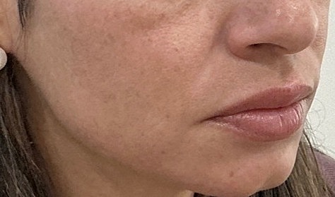 Dermal Filler  Before & After