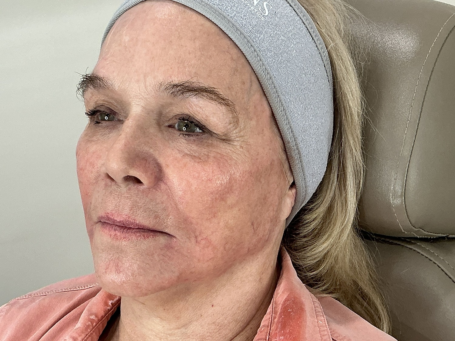 Dermal Filler  Before & After