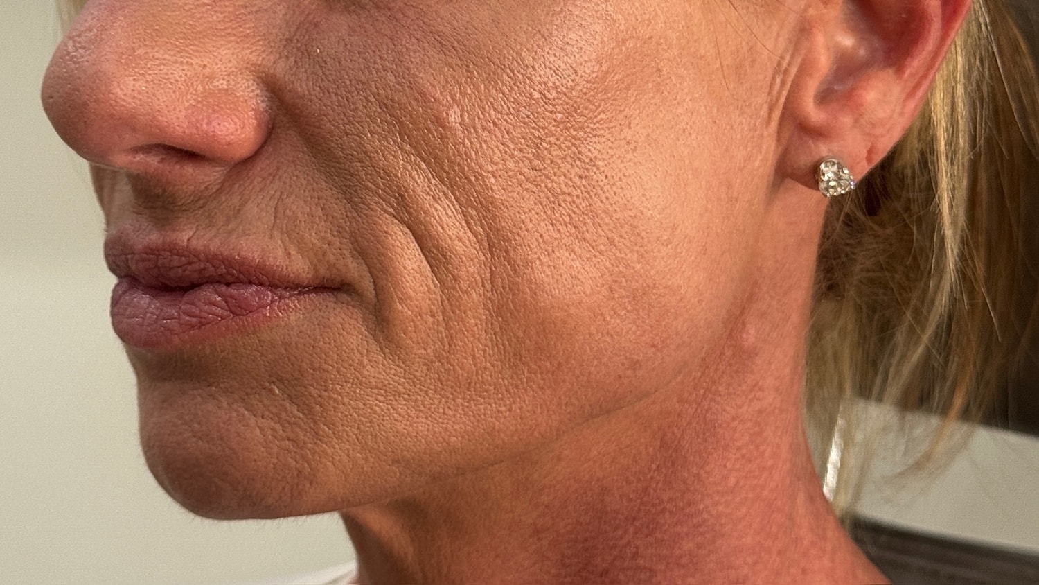 Dermal Filler  Before & After