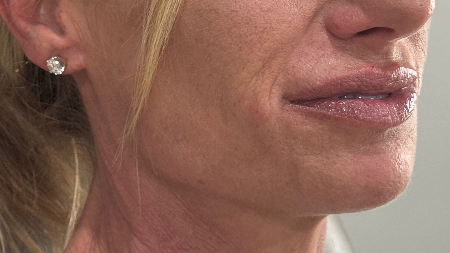 Dermal Filler  Before & After