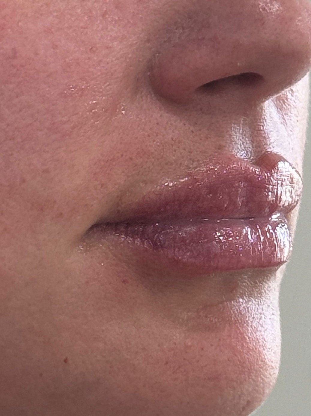 Dermal Filler  Before & After