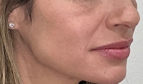 Dermal Filler  Before & After