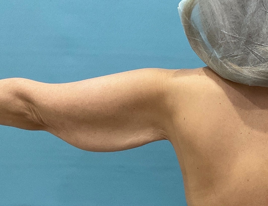 Arm Lift  Before & After
