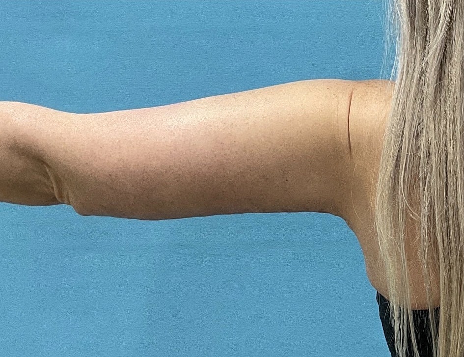 Arm Lift  Before & After