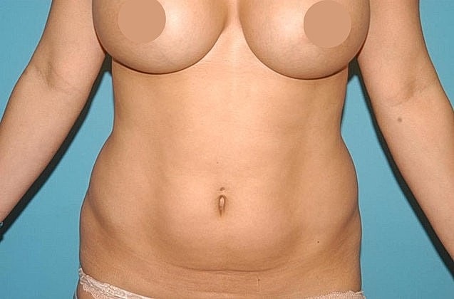Liposuction Before & After