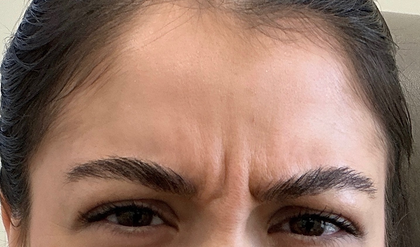 Botox  Before & After