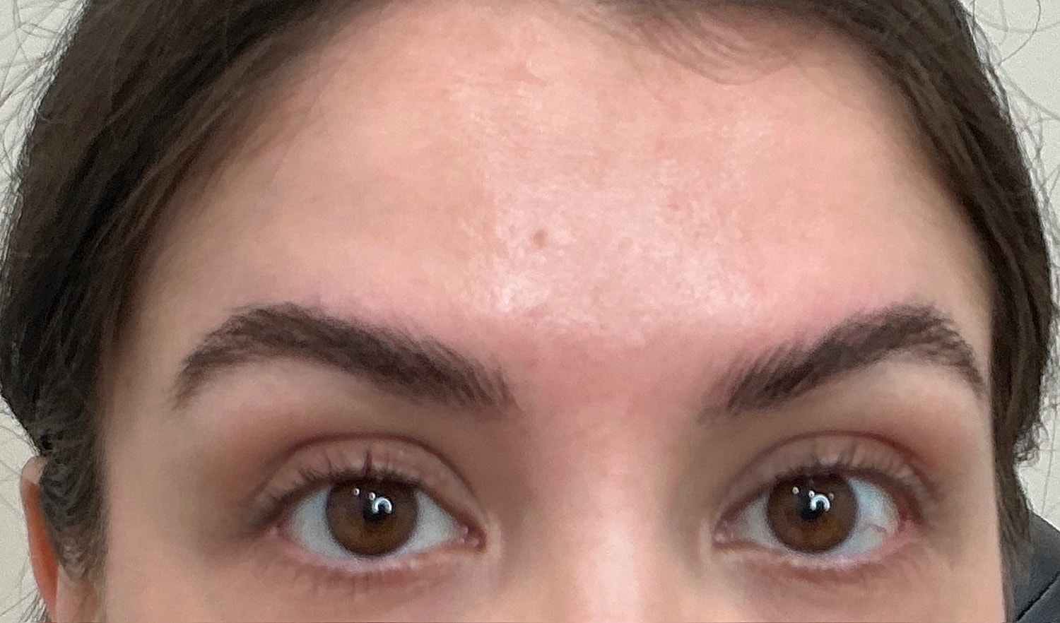 Botox  Before & After