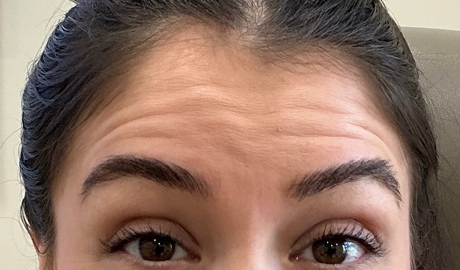 Botox  Before & After