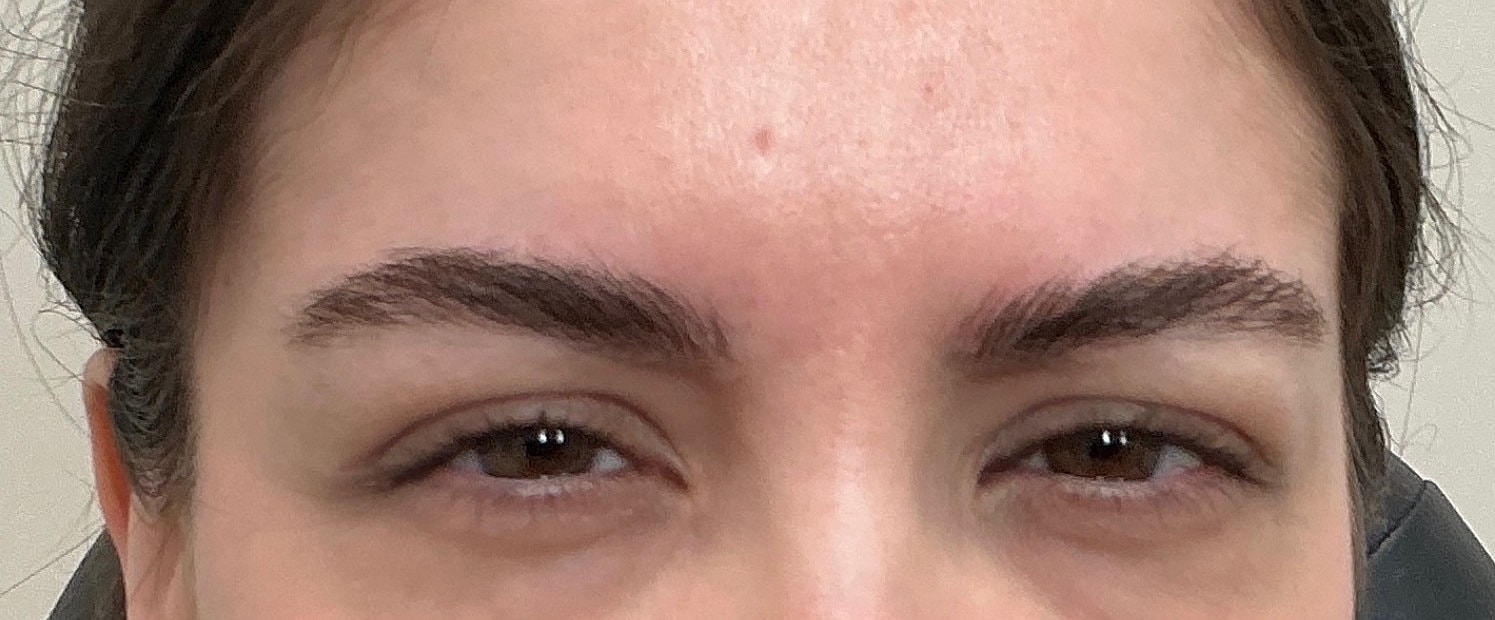 Botox  Before & After