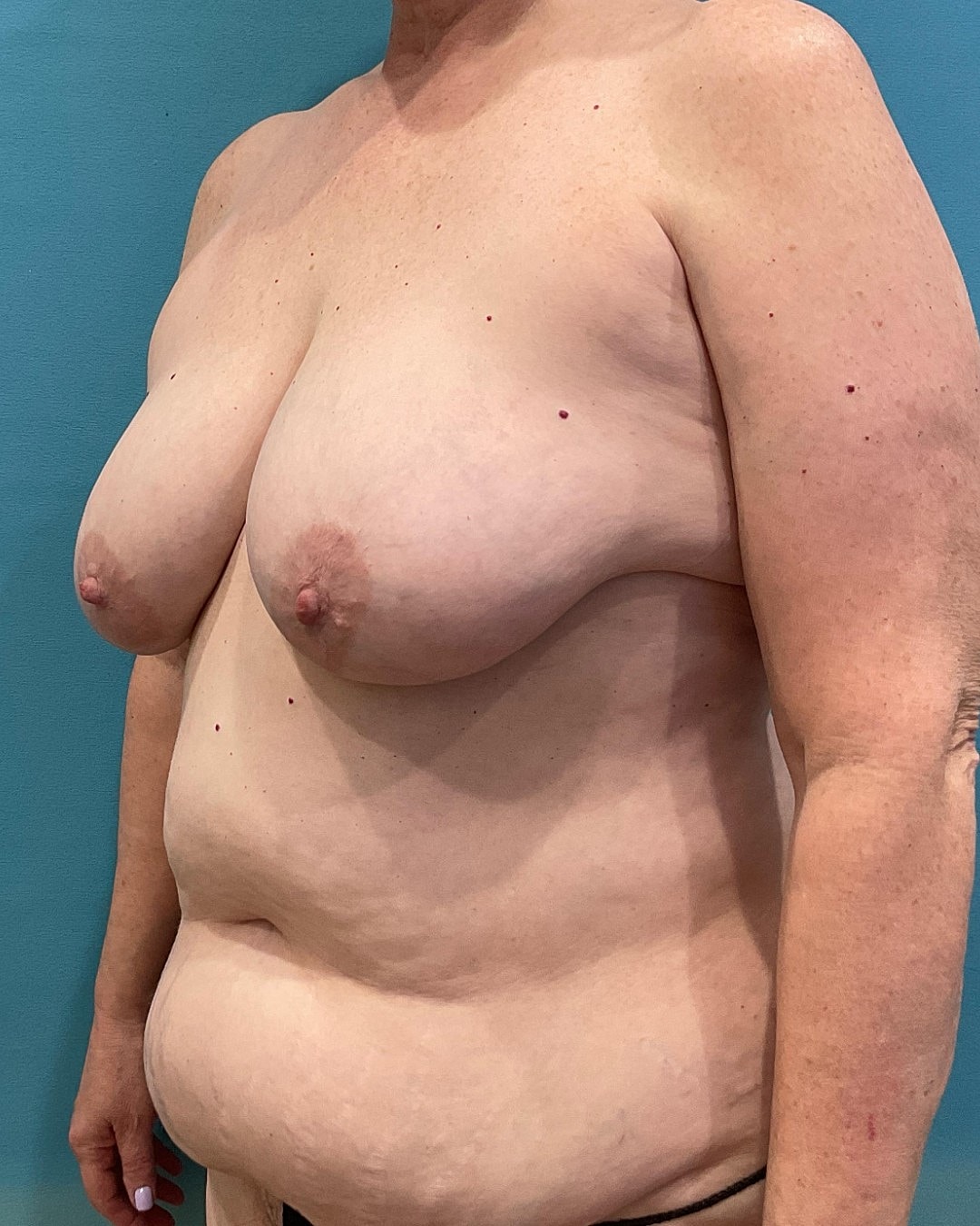 Tummy Tuck  Before & After