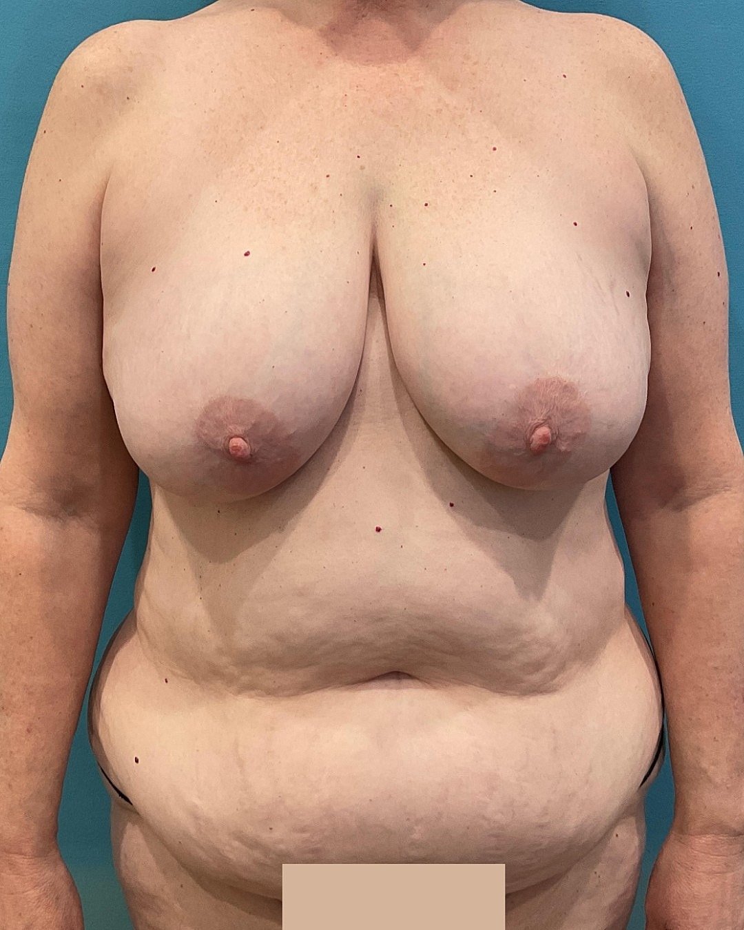 Tummy Tuck  Before & After