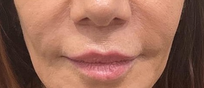 Lip Lift Before & After