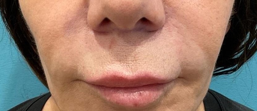 Lip Lift Before & After